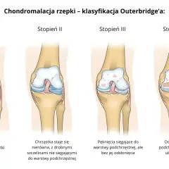 Ilustracja pokazuje cztery stopnie chondromalacji rzepki wg klasyfikacji Outerbridge'a: od zmiękczenia chrząstki do odsłonięcia kości.