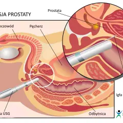 TRUS: Co to za badanie? Diagnostyka prostaty krok po kroku