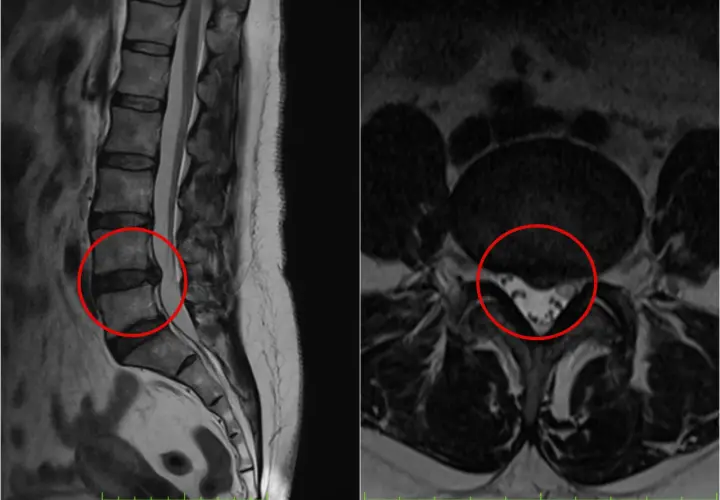 Widoczne na obrazach MRI kręgosłupa lędźwiowego zmiany wskazują na nieleczoną przepuklinę krążka międzykręgowego, uciskającą na struktury nerwowe.