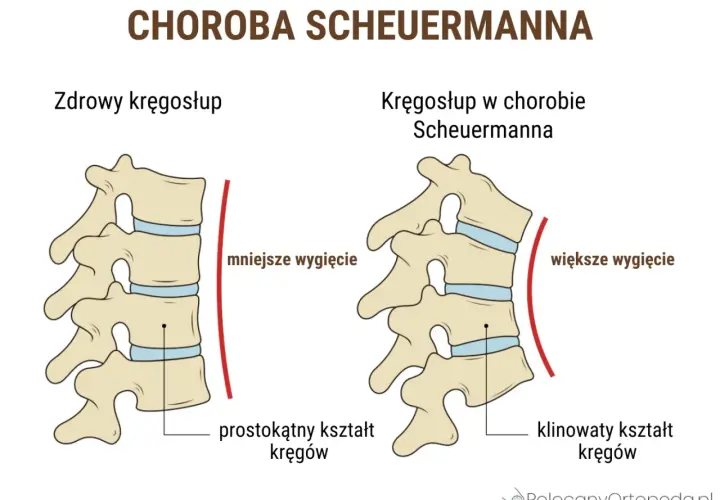 Porównanie zdrowego kręgosłupa z kręgosłupem w chorobie Scheuermanna. Widoczne klinowate kręgi i większe wygięcie.