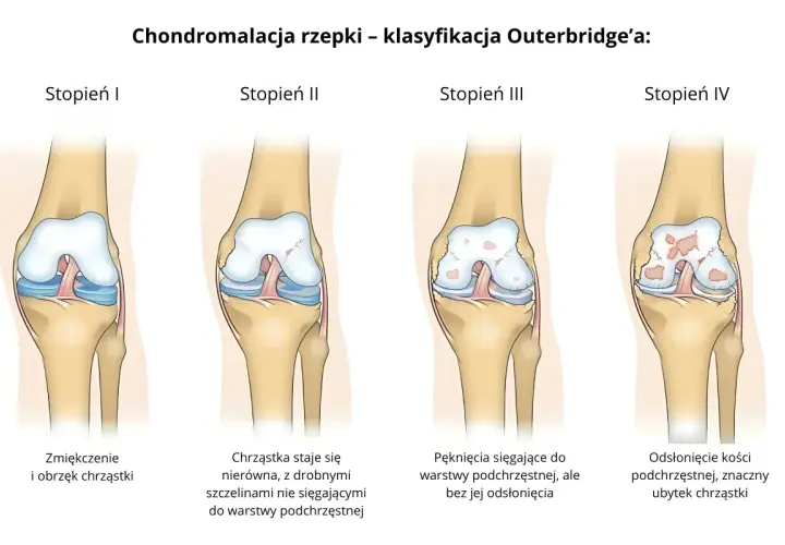 Ilustracja pokazuje cztery stopnie chondromalacji rzepki wg klasyfikacji Outerbridge'a: od zmiękczenia chrząstki do odsłonięcia kości.