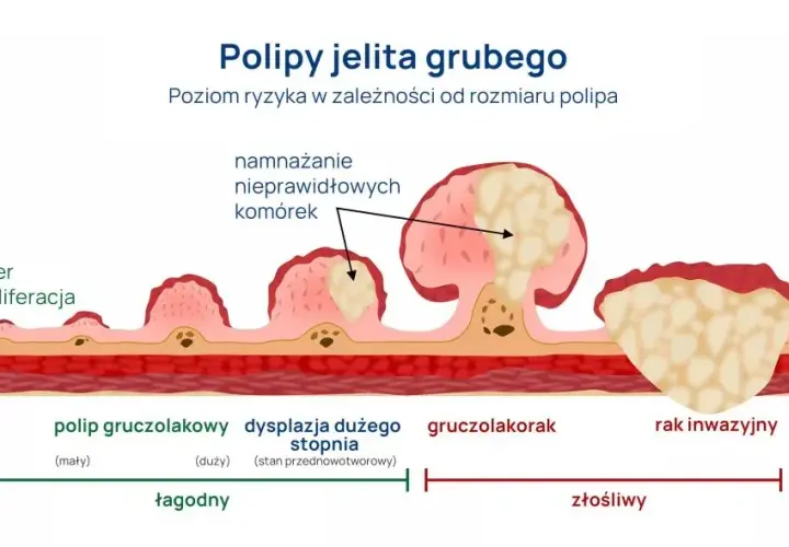 Rak jelita grubego: Czy badanie krwi wystarczy do diagnozy?
