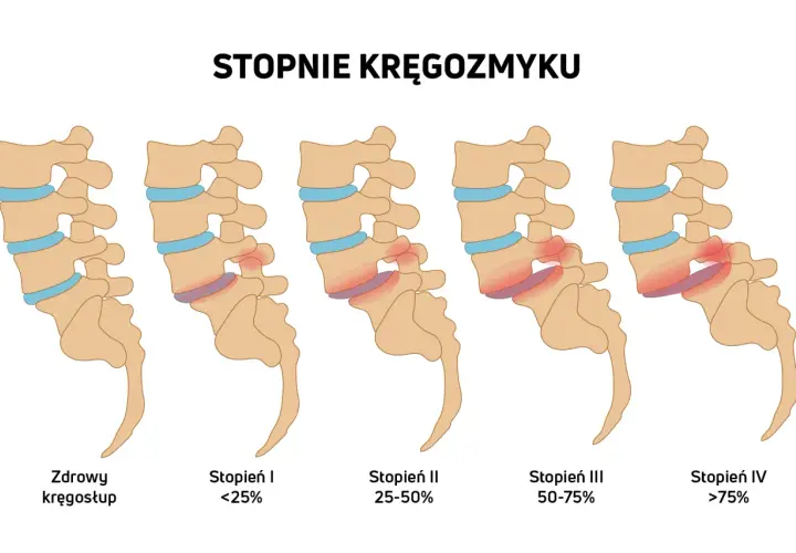 Ilustracja pokazuje stopnie kręgozmyku od zdrowego kręgosłupa do zaawansowanego kręgozmyku IV stopnia.