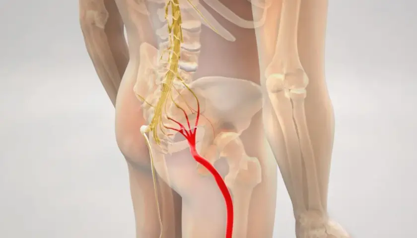Anatomical illustration showing the sciatic nerve highlighted in red, originating from the lower spine and extending down the leg.