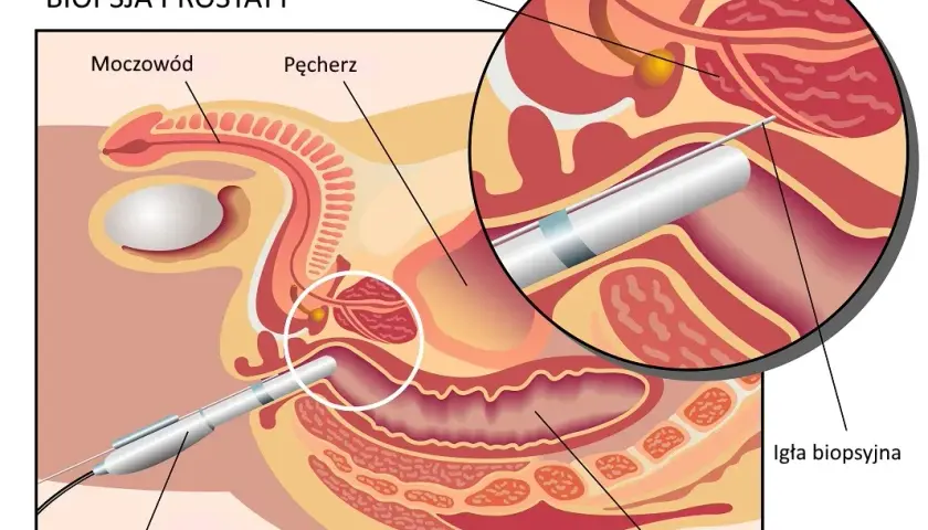 TRUS: Co to za badanie? Diagnostyka prostaty krok po kroku