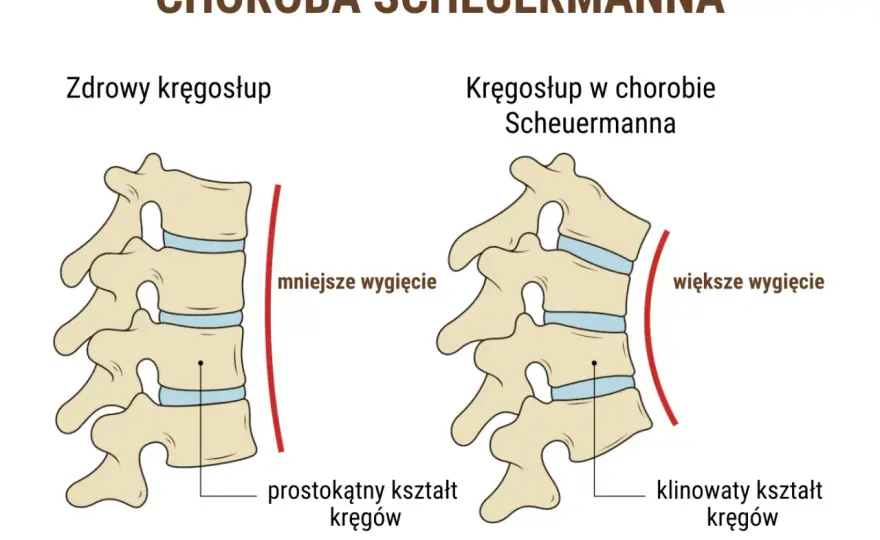 Choroba Scheuermanna - objawy, leczenie i kiedy operacja?