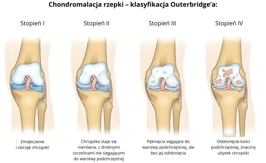 Chondromalacja rzepki - skąd ból i co naprawdę pomaga?