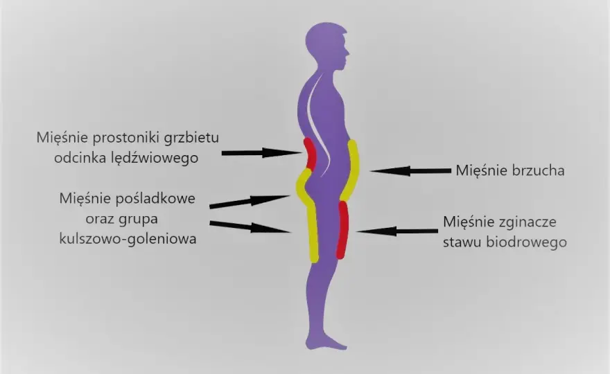Lordoza lędźwiowa - czy to problem? Objawy, leczenie i ćwiczenia