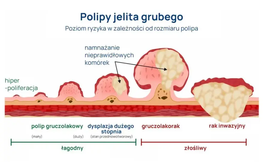 Rak jelita grubego: Czy badanie krwi wystarczy do diagnozy?