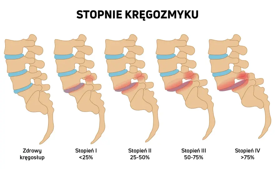 Kręgozmyk - objawy, badania i leczenie bez operacji