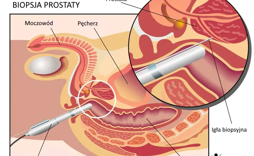 TRUS: Co to za badanie? Diagnostyka prostaty krok po kroku