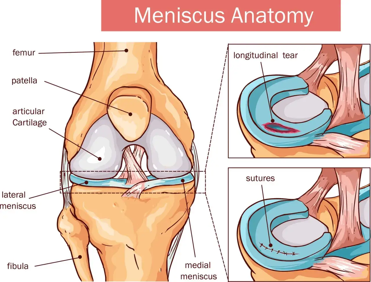 Anatomia kolana: uszkodzenie i zszycie łąkotki. Widok kości udowej, rzepki, piszczeli i strzałki.