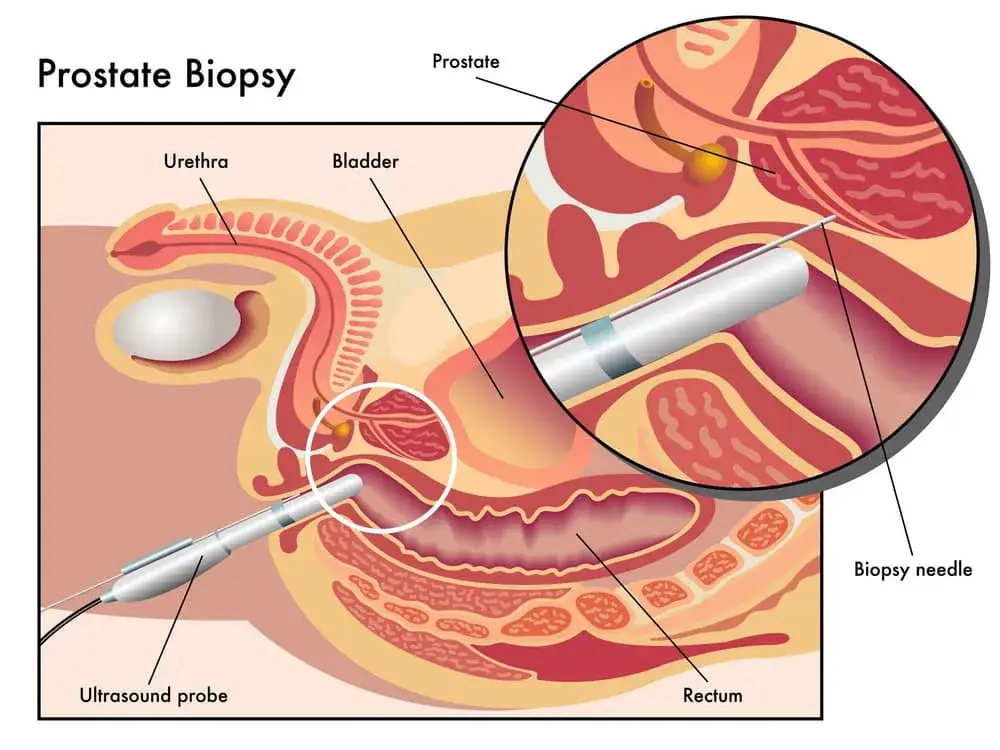 biopsja prostaty pod kontrolą TRUS